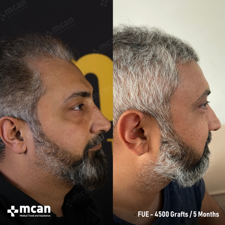 FUE Hair Transplant Before & Afters 4500 Grafts 1