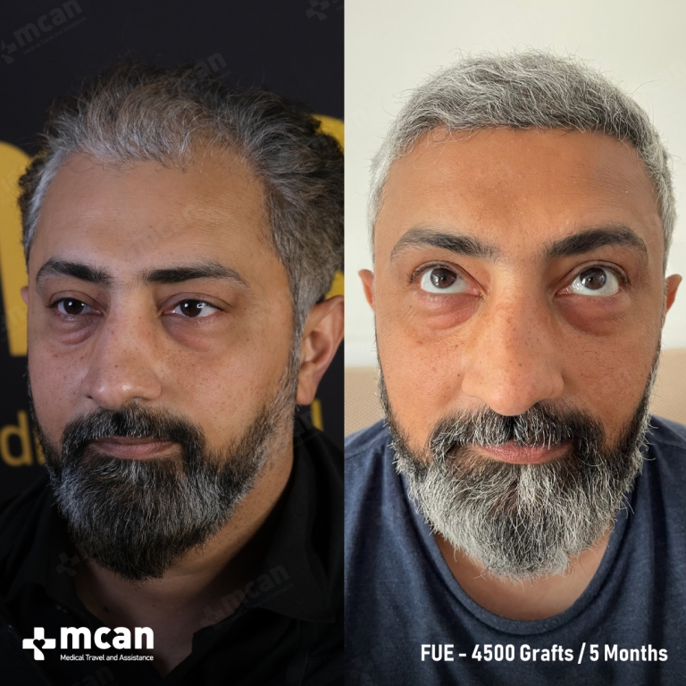 FUE Hair Transplant Before & Afters 4500 Grafts 2