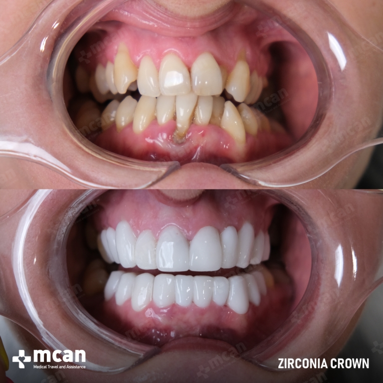Zirconium Crown Before and After