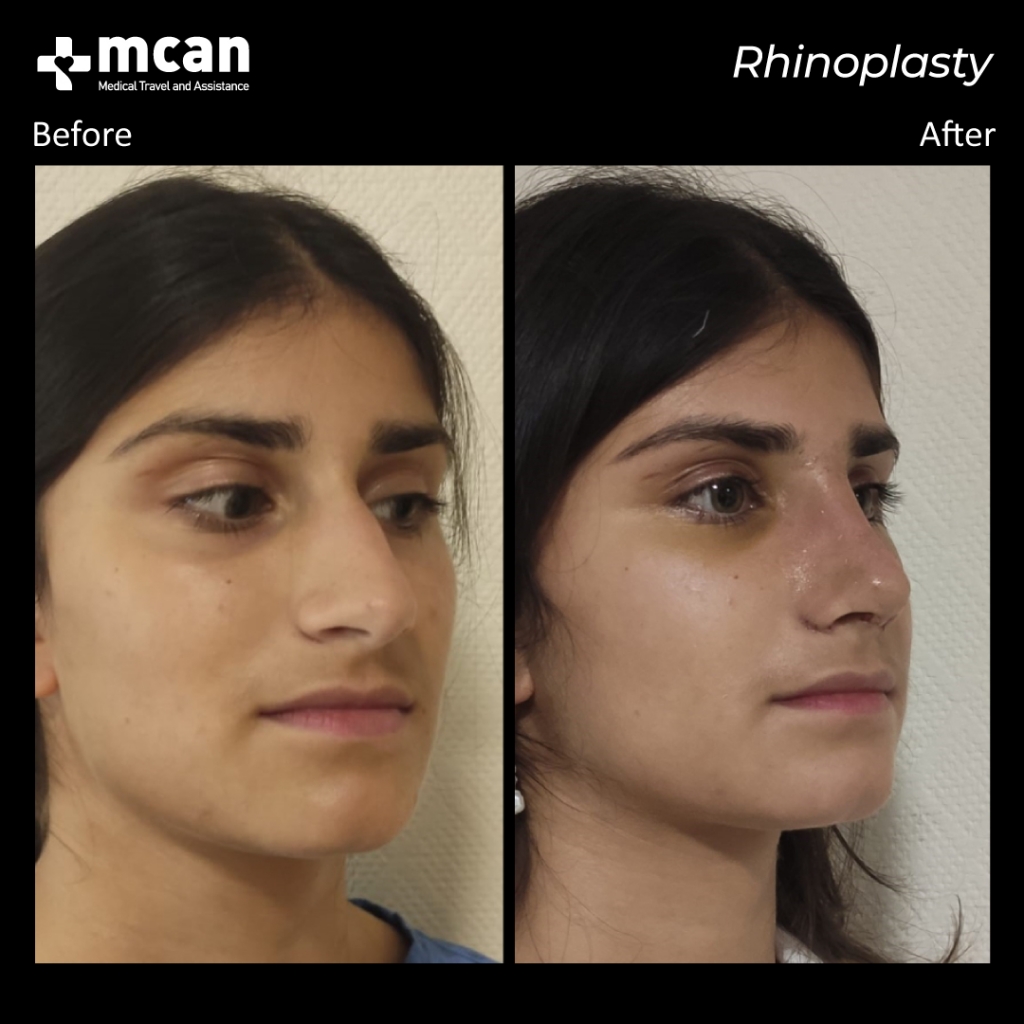 female nose job before after
