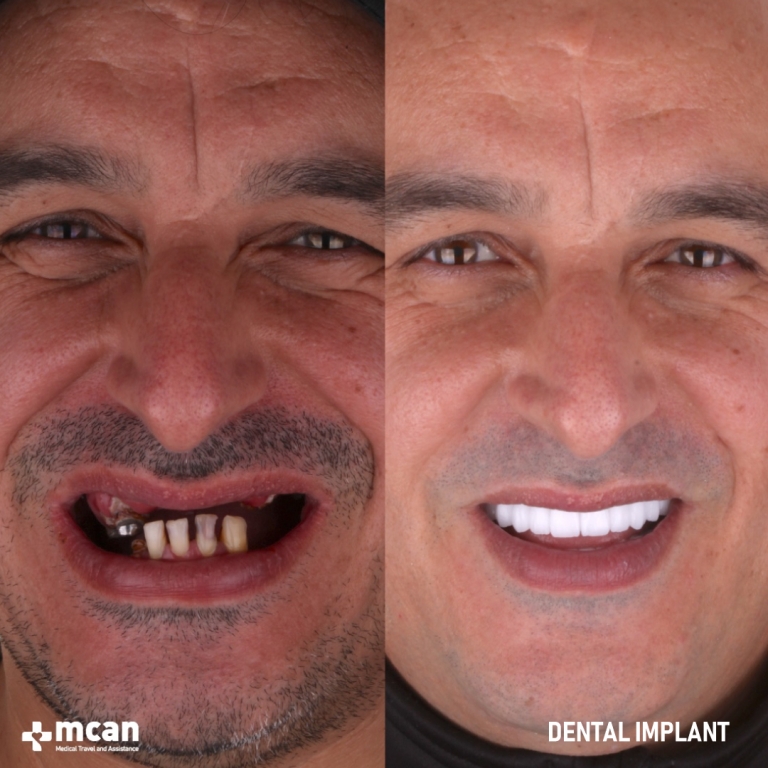 Dental Implant Before and After