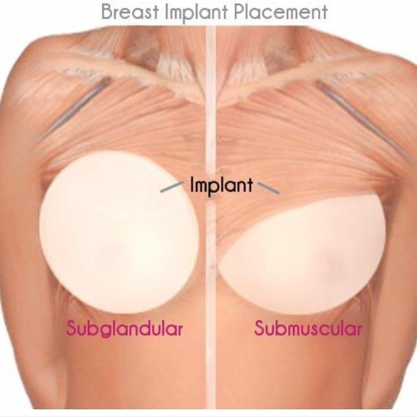 natural looking boob job implant placement 