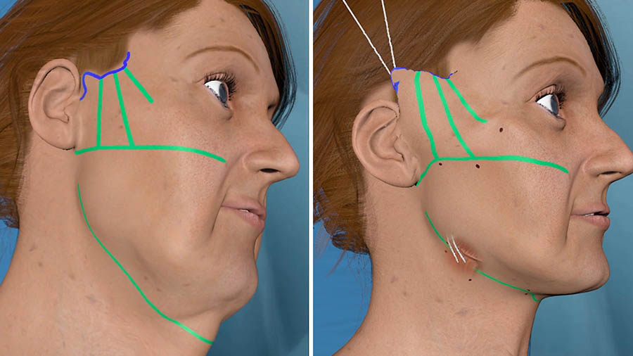 la foto de incisiones de lifting facial profundo