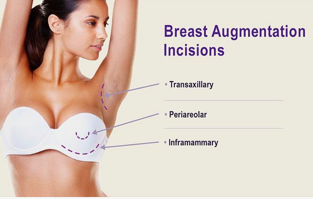 breast augmentation incision sites 
