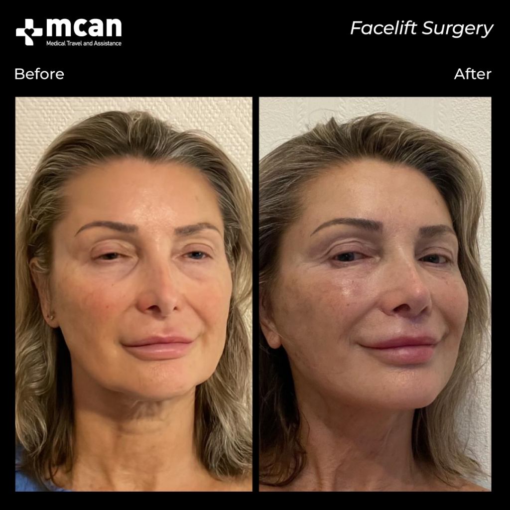lifting facial antes y despues con mcan health 1