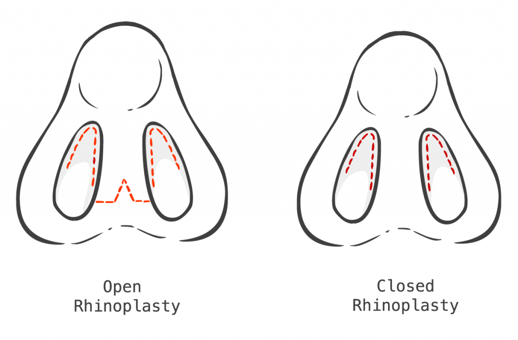 open or closed nose job 