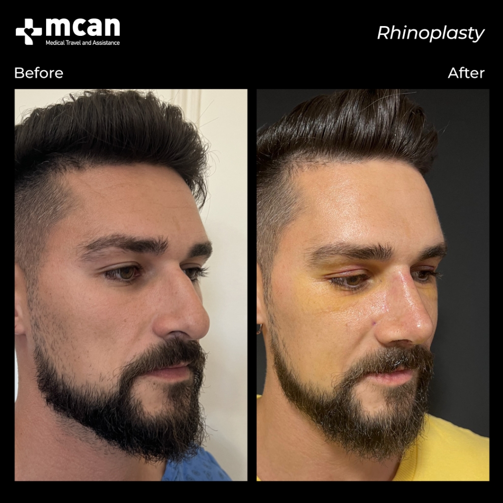 rinoplastia con MCAN Health antes y despues 3