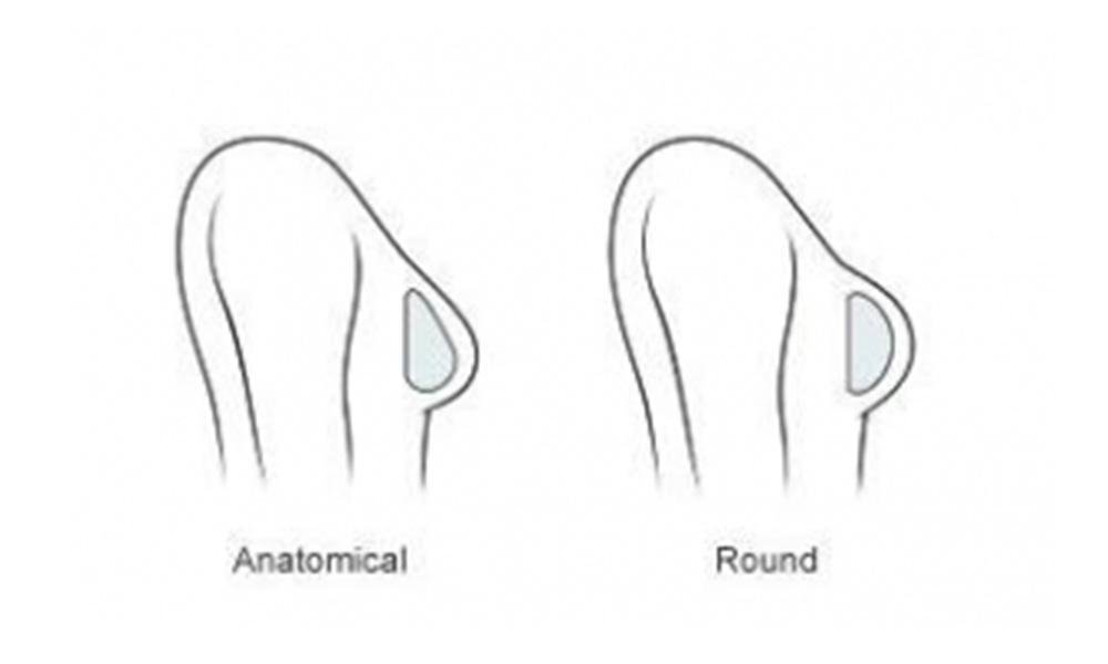 round vs teardrop implant