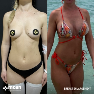 Breast Enlargement Before After 1