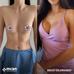 Breast Enlargement Before After 6