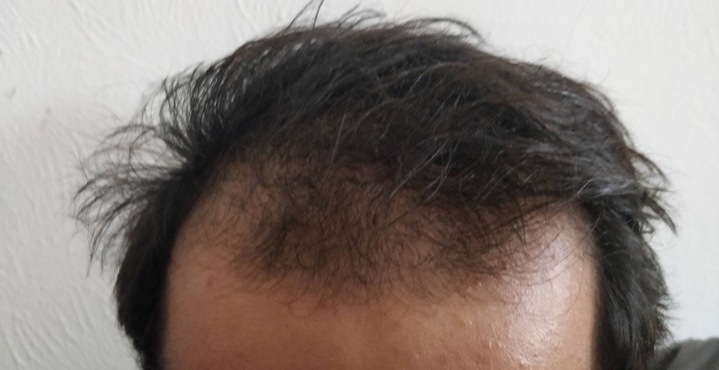 la perdida de cabello por estress