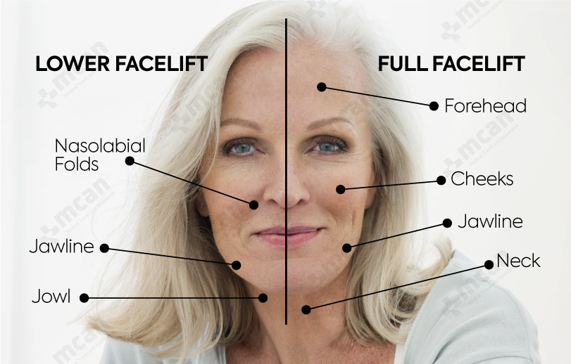 full facelift vs lower facelift difference with mcan health 