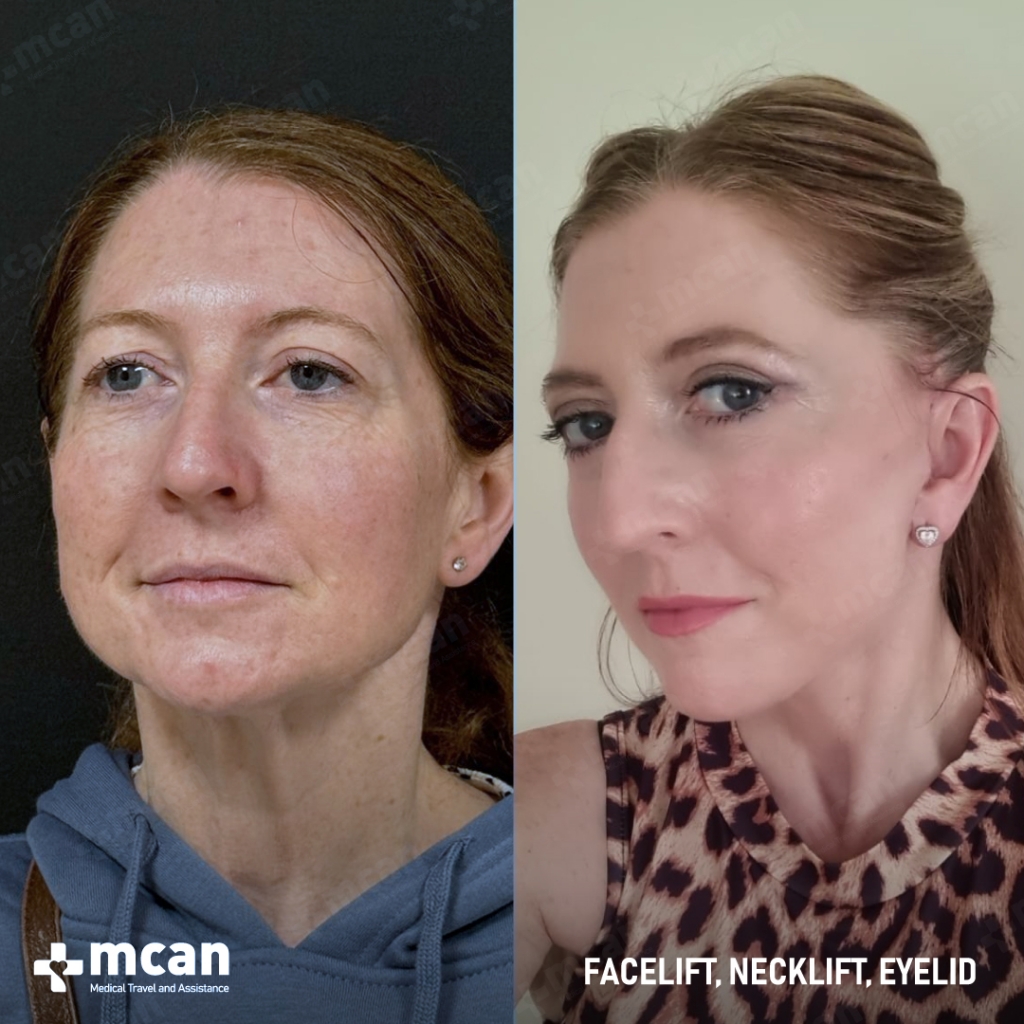 mcan health facelift before and after 