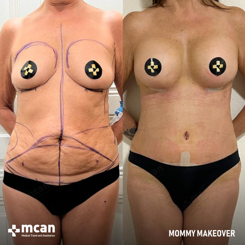 mcan health mommy makeover surgery 