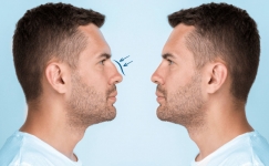 un blog sobre rinoplastia masculina