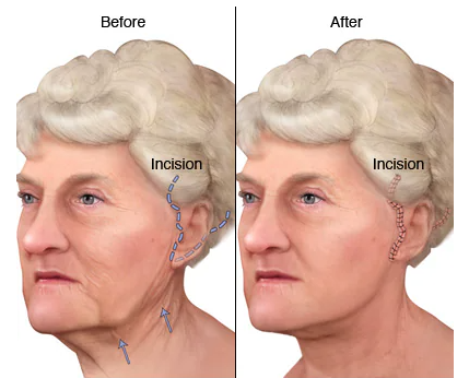 full facelift surgery 