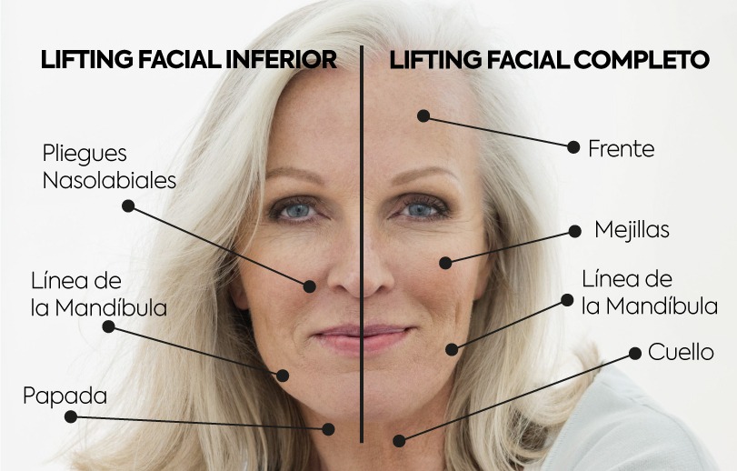 diferencias sobre lifting facial completo y inferior 