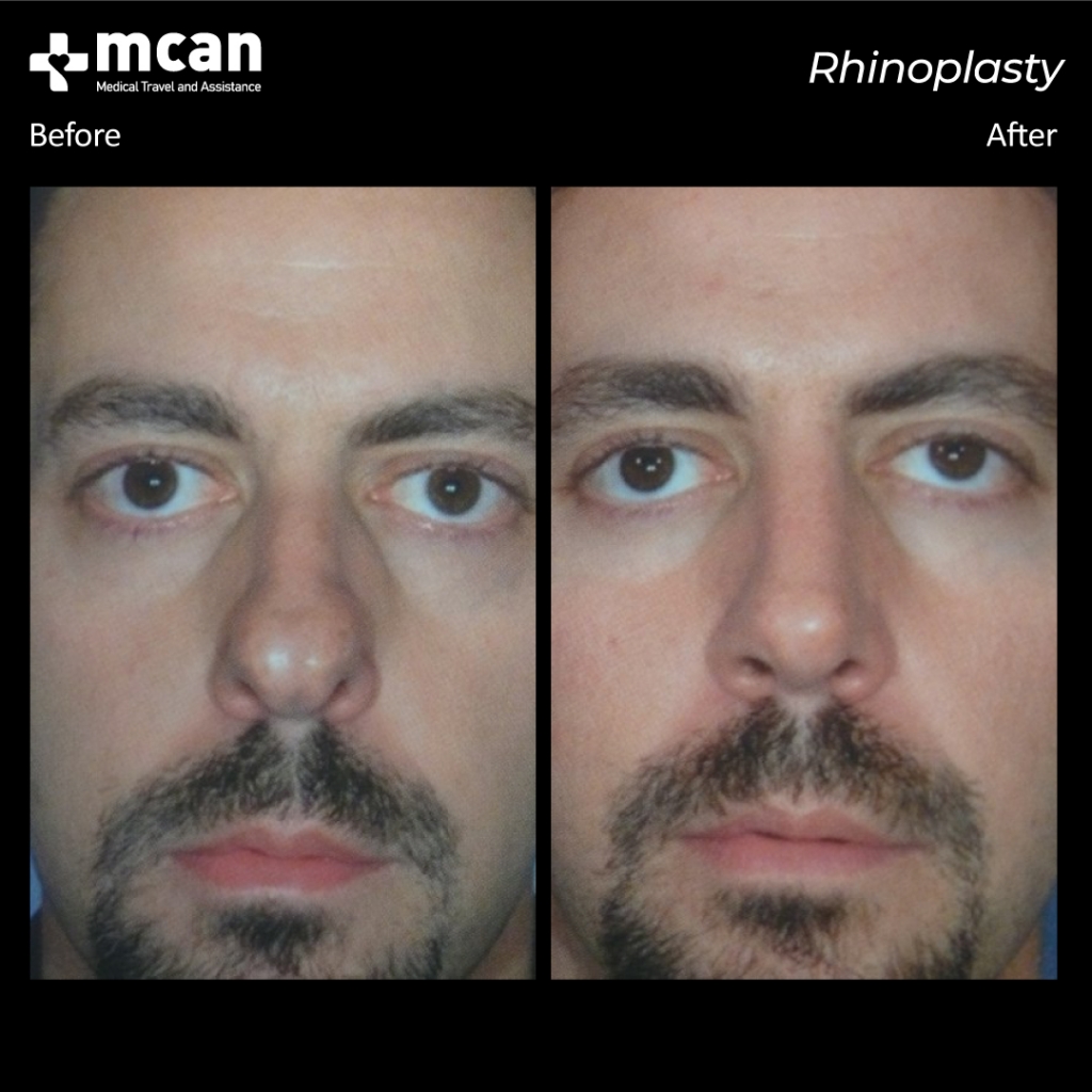 antes y despues rinoplastia