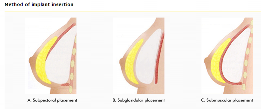 breast implant insertation techniques 