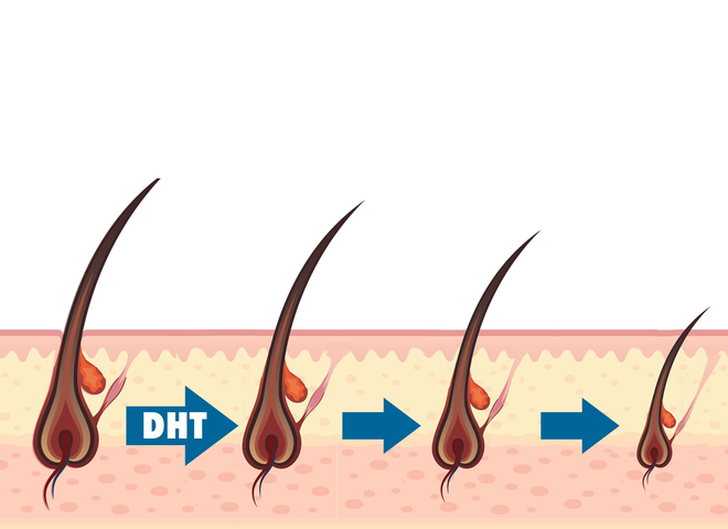 dht hormone for hair loss