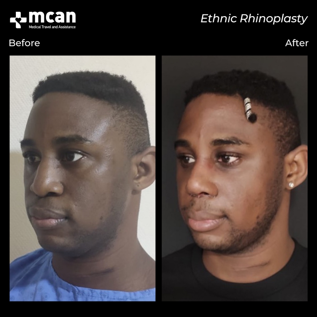 male rhinoplasty mcan health before after 