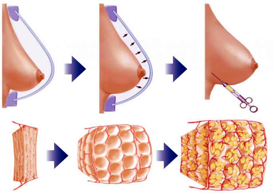 breast augmentation with fat grafting 