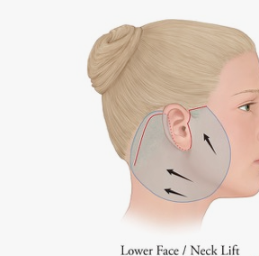 lifting facial inferior