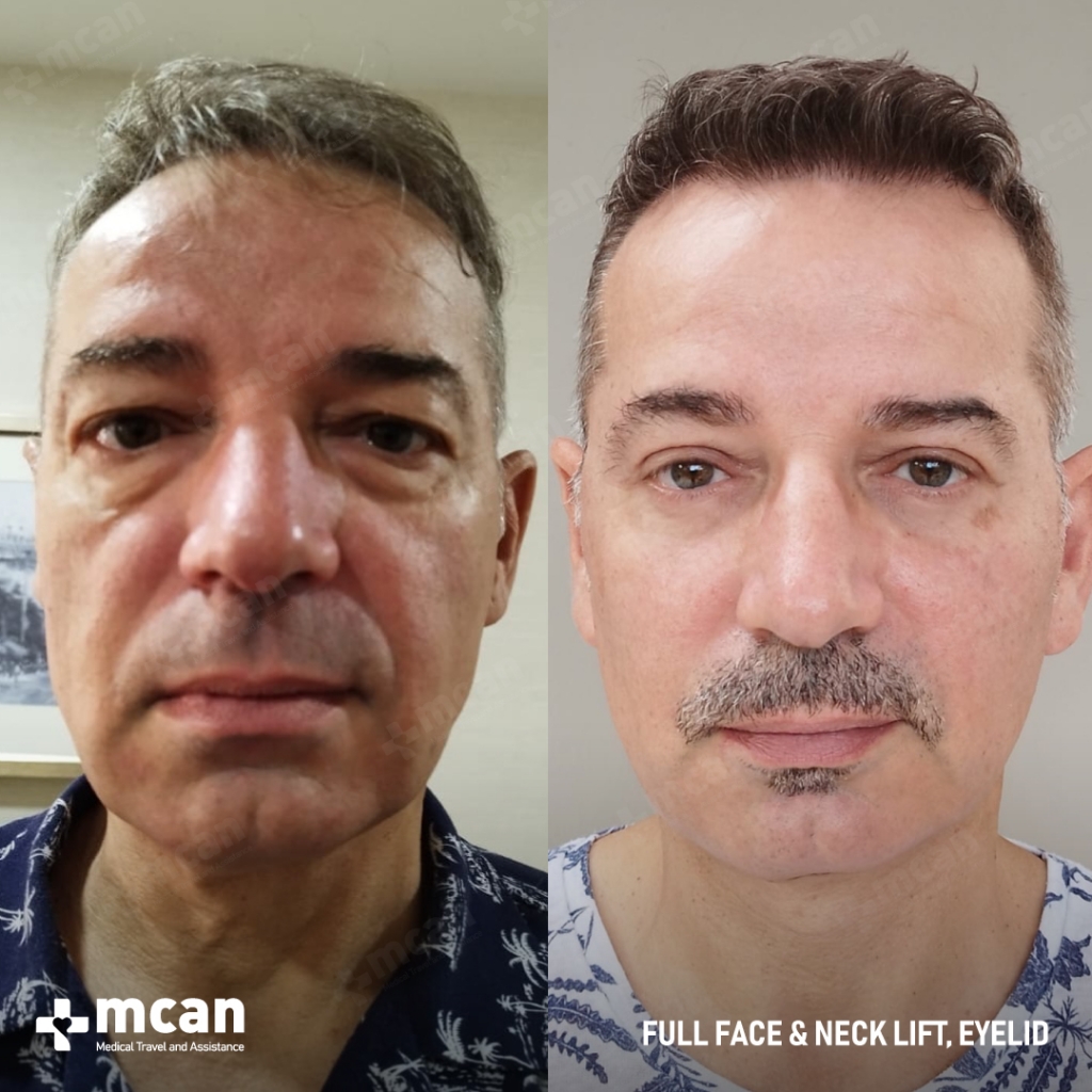 lifting facial antes y despues con mcan health  en estambul