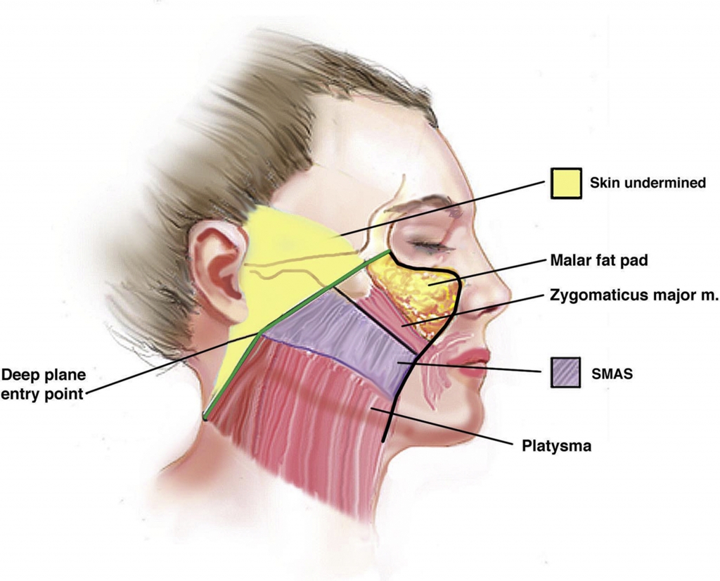 lifting facial profundo y lifting facial SMAS