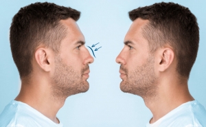 a blog about male rhinoplasty written by mcan health