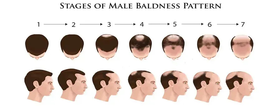 norwood scale for hair loss