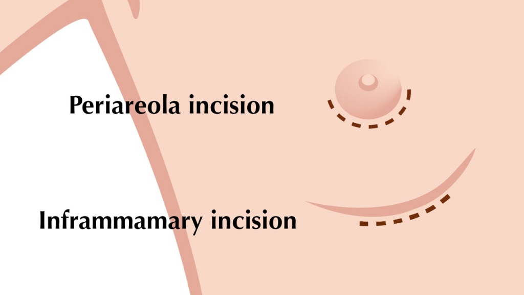 surgical incision for breast surgeries 