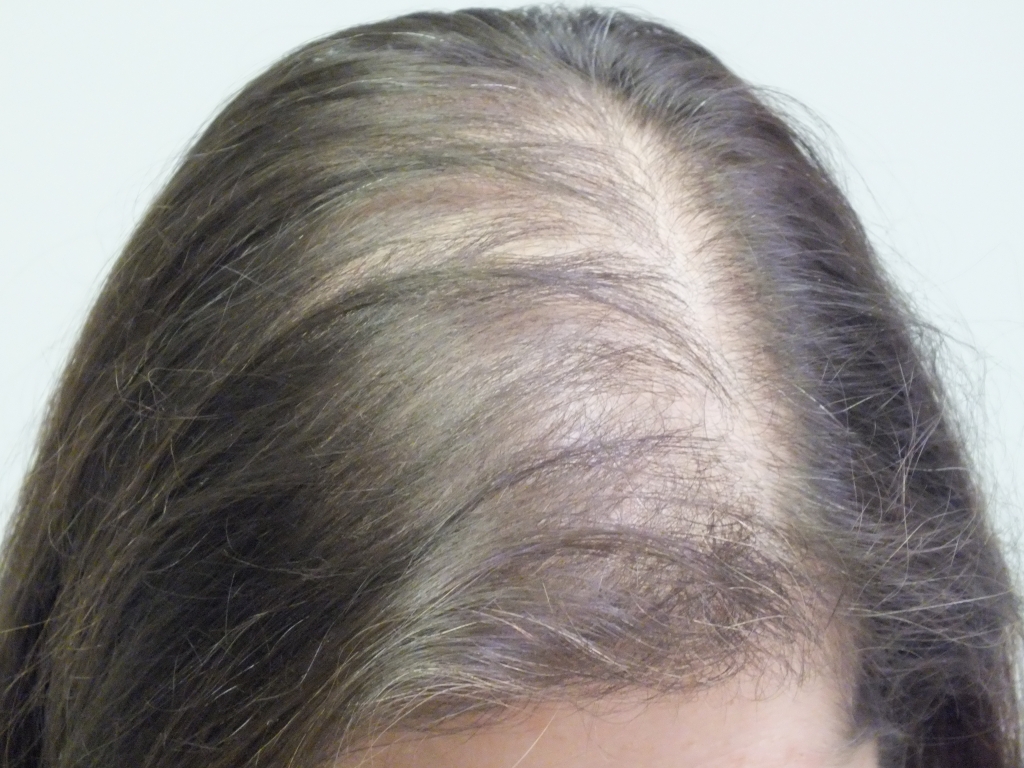 post partum hair loss in women