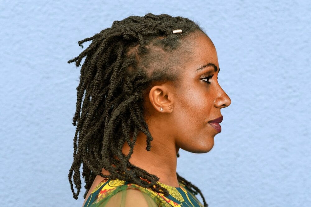 traction alopecia 