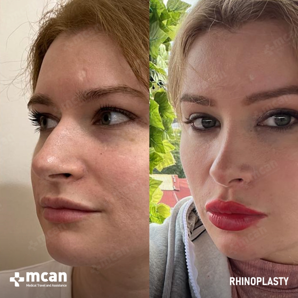 mcan health rhinoplasty before and after 