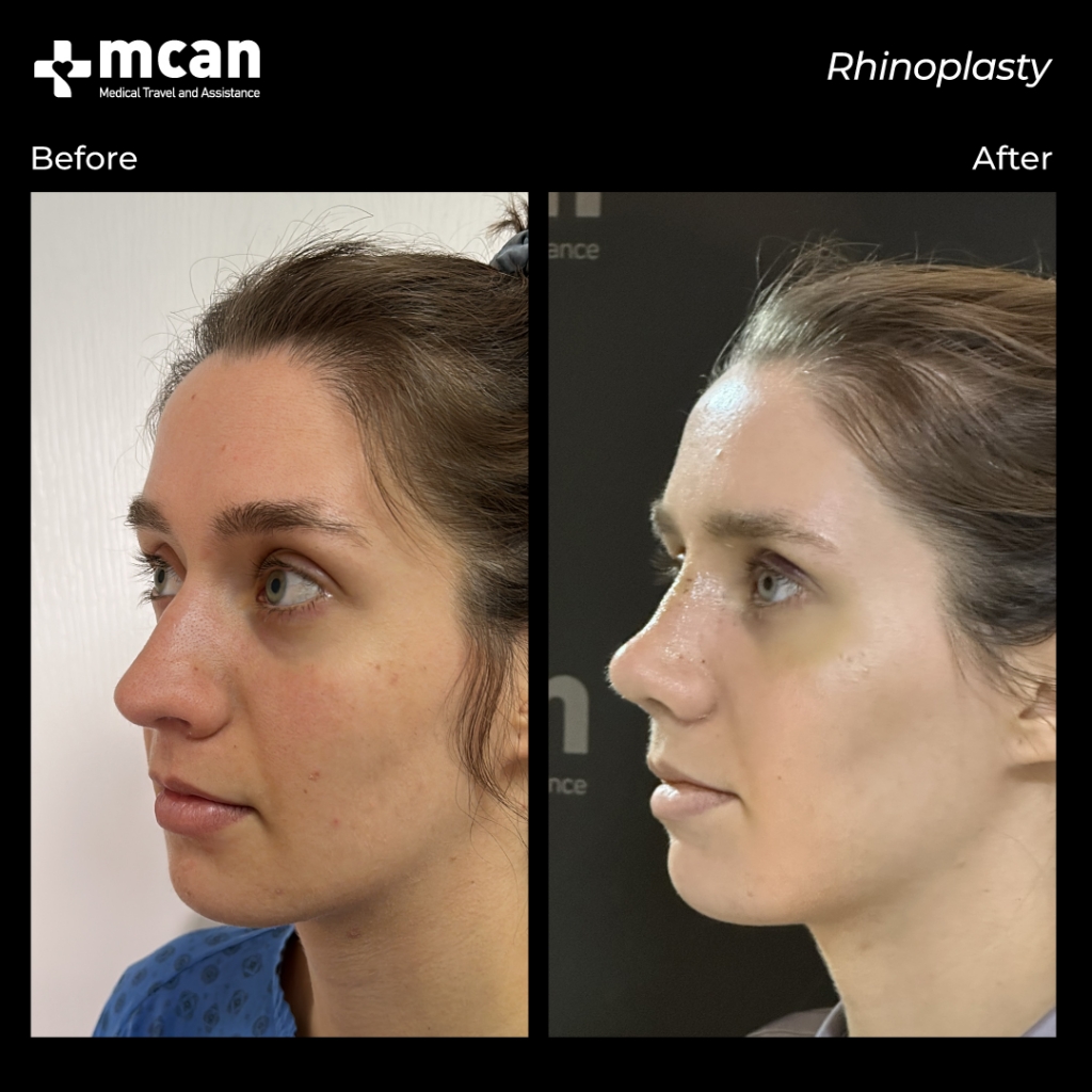 mcan health rhinoplasty before and after