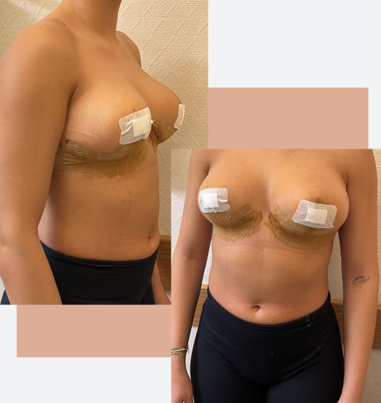 Breast lift transformations