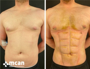 Gynecomastia Results 1