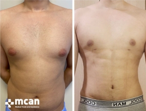 Gynecomastia Results 2