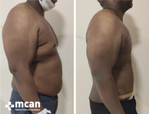 Gynecomastia Results 3