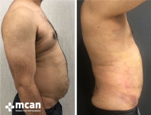 Gynecomastia Results 6