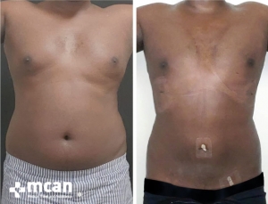 Gynecomastia Results 7