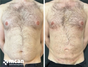 Gynecomastia Results 8