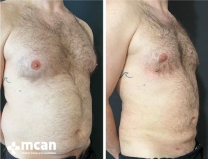 Gynecomastia Results 9