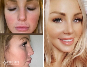 Rhinoplasty in Turkey Before and After 1