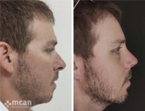 Rhinoplasty in Turkey Before and After 11