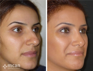 Rhinoplasty in Turkey Before and After 12