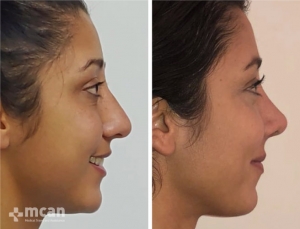 Rhinoplasty in Turkey Before and After 13