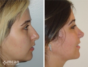 Rhinoplasty in Turkey Before and After 14