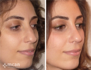 Rhinoplasty in Turkey Before and After 15